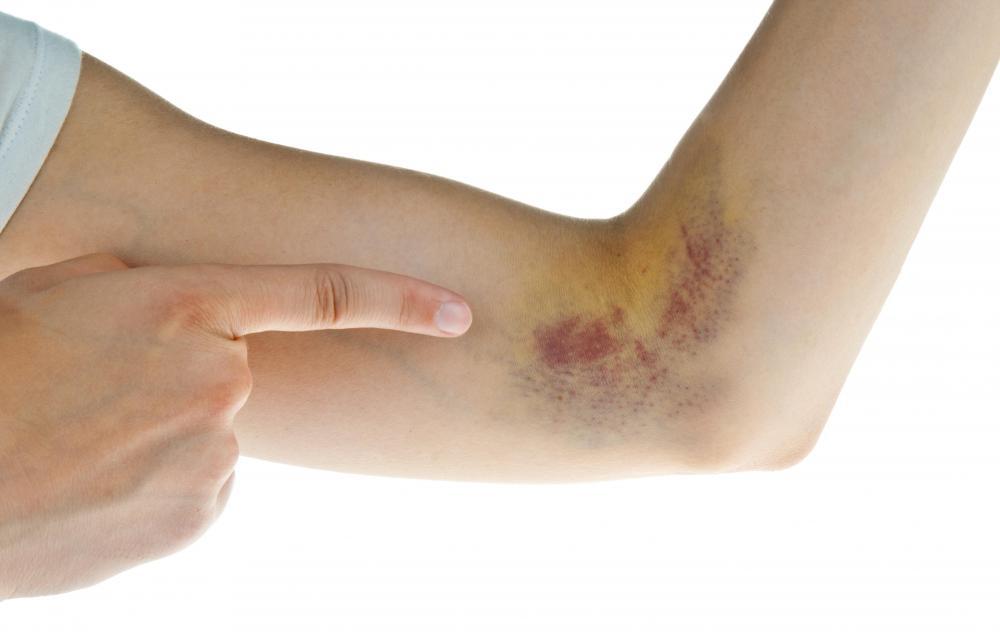 Thi thoảng những vết bầm tím xuất hiện trên tay hoặc chân, ấn vào thấy đau.