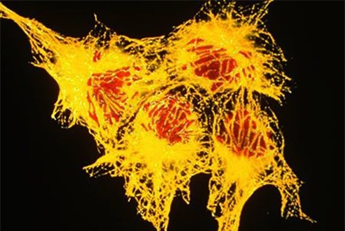 Tế bào ung thư dưới kính hiển vi - Ảnh: Reuters