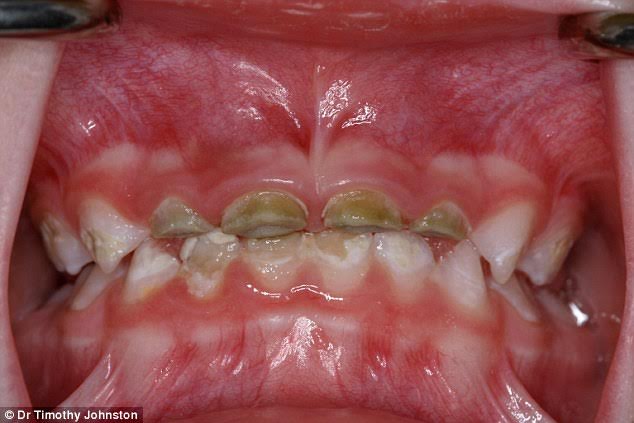 Sâu răng là do vi khuẩn trong miệng sẽ làm xói mòn bề mặt của răng, gây thiệt hại đáng kể cho cấu trúc của răng (trong ảnh là một em bé dưới 10 tuổi).