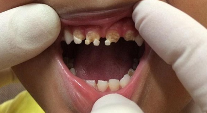 Cậu bé 3 tuổi trải qua ca phẫu thuật nha khoa lớn khi bị nhổ 11 răng hỏng.