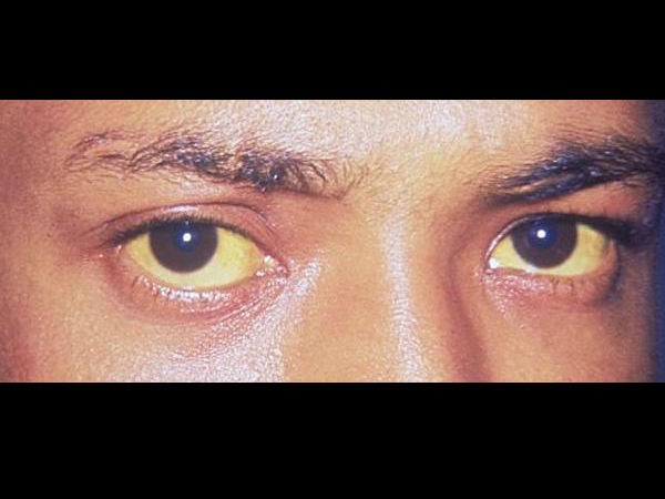 Nếu bạn nhận thấy đôi mắt hoặc da chuyển màu vàng, đây có thể là dấu hiệu đáng báo động vì đây là tác dụng phụ nghiêm trọng của thuốc tránh thai. Hãy tham khảo ý kiến bác sĩ ngay lập tức về trường hợp này. 