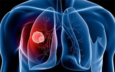 Nam giới thường hút thuốc lá nên có nguy cơ mắc ung thư phổi rất cao