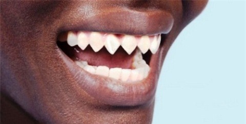 Hàm răng mài theo phong cách hàm cá mập
