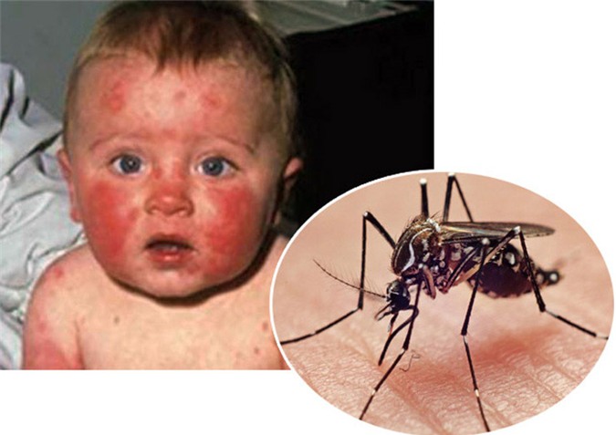 Khuyến cáo đặc biệt khi virus Zika vây kín Việt Nam - 1