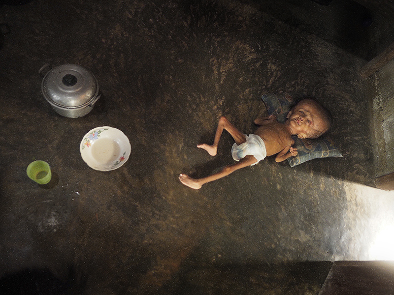 Một đứa trẻ 9 tuổi người Indonesia bị nhiễm độc thuỷ ngân do mẹ làm việc tại mỏ vàng khi mang thai. Ảnh: Pulitzercenter