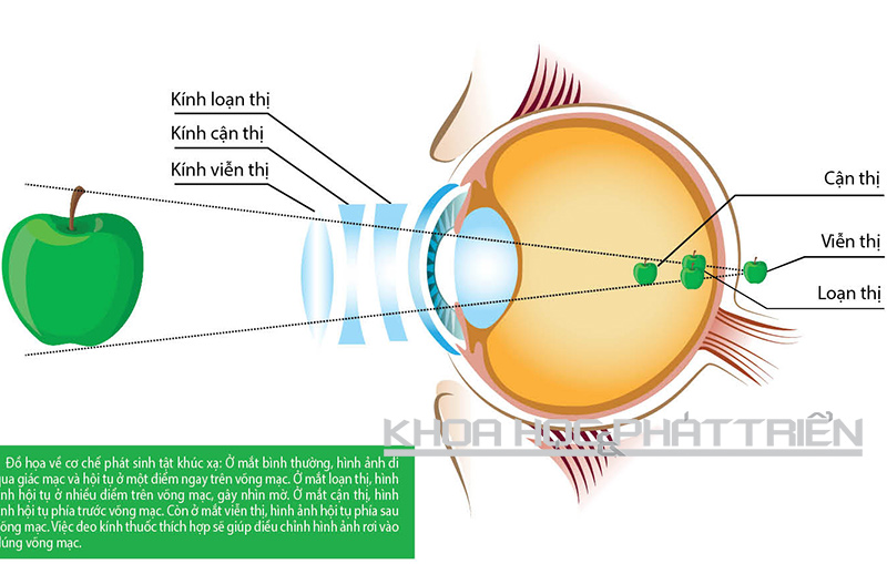 Đồ họa mô tả các tật khúc xạ về mắt.