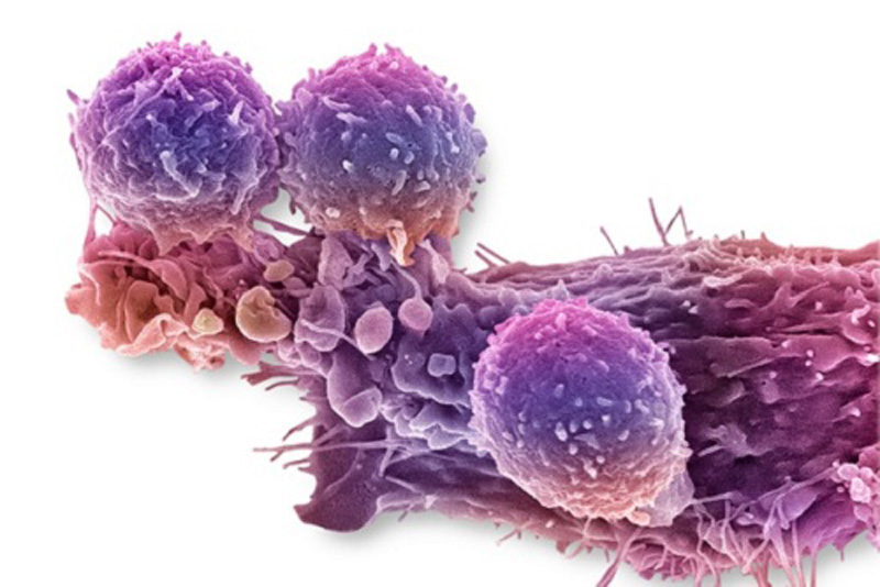 Tế bào miễn dịch trong máu người bệnh sẽ được chèn mã di truyền mới giúp tăng cường khả năng tiêu diệt tế bào ung thư.