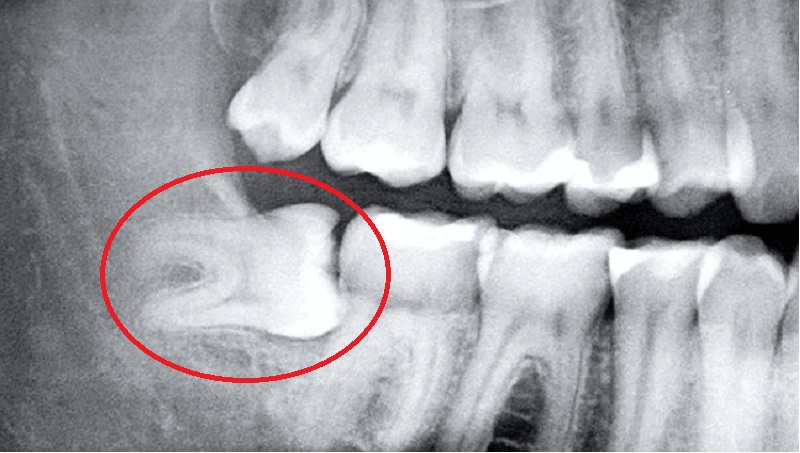 Hình ảnh X-quang của một chiếc răng khôn mọc ngang.