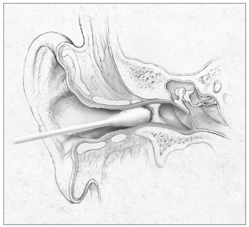 Dùng tăm bông ngoáy tai sai cách, người phụ nữ phải nhập viện vì mủ chảy ra ngoài - 2