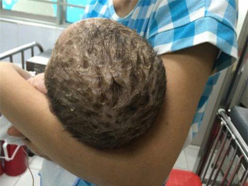 Tắm lá chữa thủy đậu, bé trai 4 tháng tuổi bị nhiễm độc da toàn thân - 1