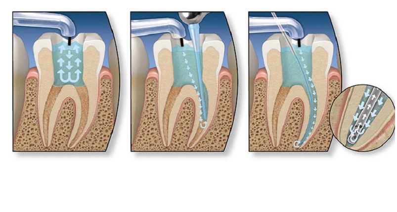 Hình ảnh minh họa quá trình lấy tủy răng.