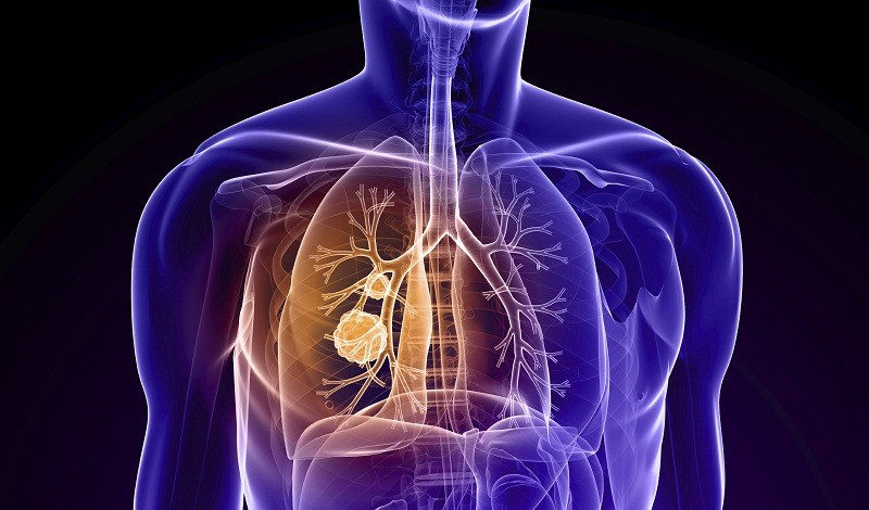 1. Bệnh tắc nghẽn phổi mãn tính là bệnh lý tắc nghẽn thông khí, làm giảm khả năng hô hấp của người bệnh. Ảnh minh họa.