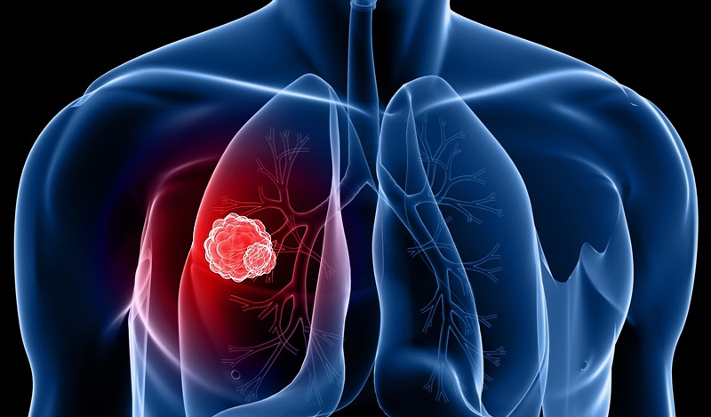 Ung thư phổi gây ra những cơn đau lưng.