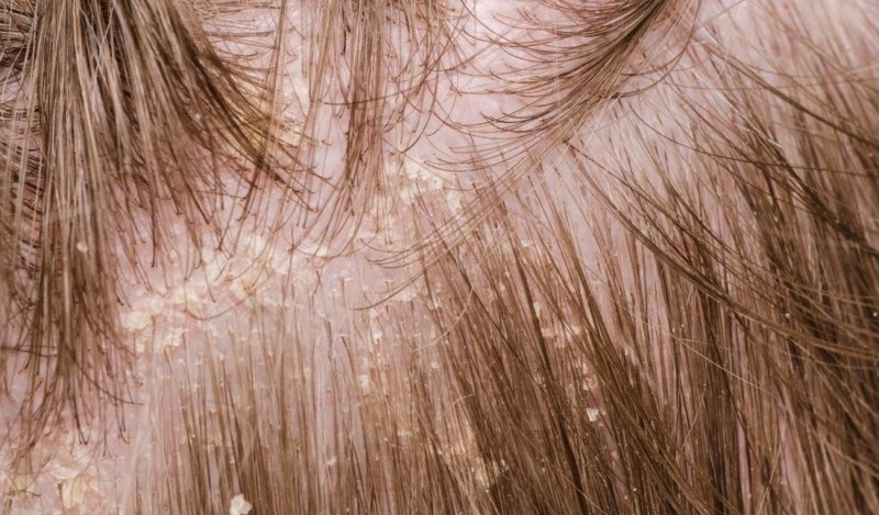 1.	Nấm tóc có hai loại nấm tóc khô và nấm tóc sinh mủ do hai loại nấm khác nhau gây ra. Ảnh minh họa.