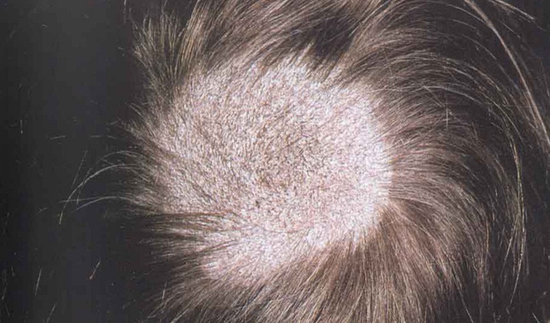 3.	Nấm tóc khô thường có triệu chứng là nột vài đốm tóc bị rụng, mỗi đốm có đường kính rộng khoảng vài centimét. Da đầu ở nơi tóc bị rụng có màu xám. Cọng tóc bị gãy rất gần với da đầu. Ảnh minh họa.