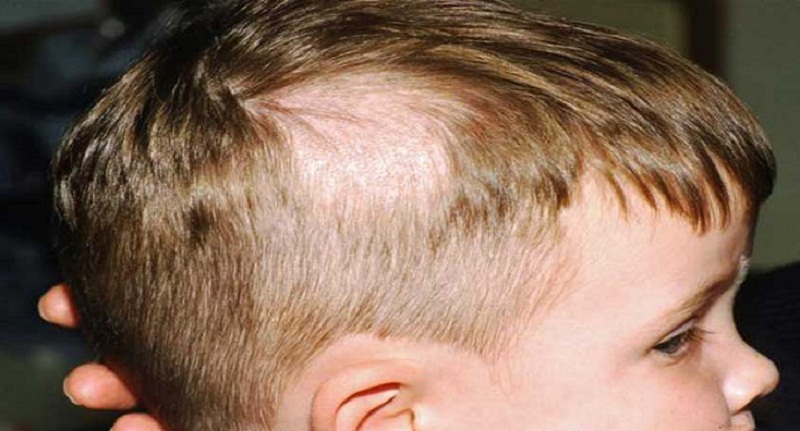 6.	Sau một thời gian thì phản ứng viêm giảm đi và tóc có thể mọc trở lại.