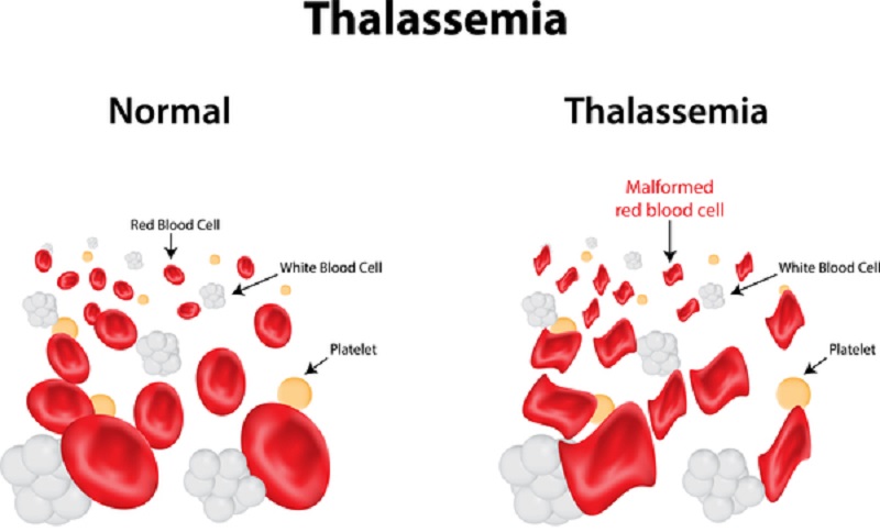 Thalassemia.