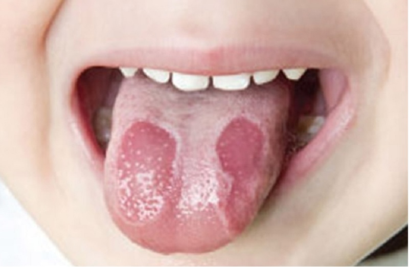 Bệnh lưỡi bản đồ ở trẻ em.