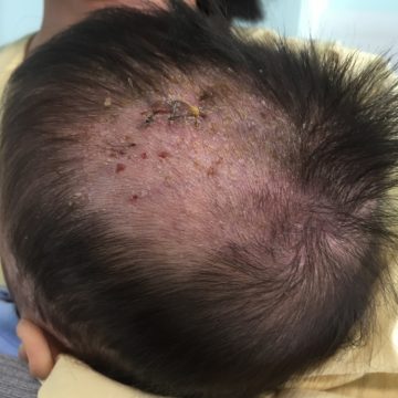  Hình ảnh vùng da đầu tổn thương của bé trai mắc hội chứng mô bào 