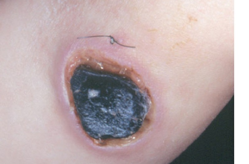 Biểu hiện ngoài da của bệnh than.