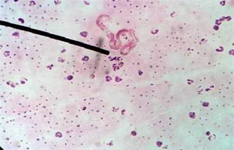 Loại kí sinh trùng sán lá ruột lớn có tên Fasciolopsis Buski