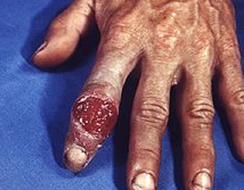 Vết loét hạ cam xuất hiện trên ngón tay ở người đàn ông đã dùng ngón tay kích dục không an toàn. Giang mai không chỉ giới hạn ở những bộ phận sinh dục, mà có thể lây truyền qua các tiếp xúc gần khác