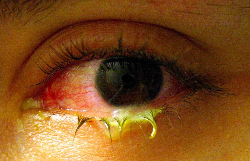 Ghèn vàng - một trong những triệu chứng của đau mắt đỏ