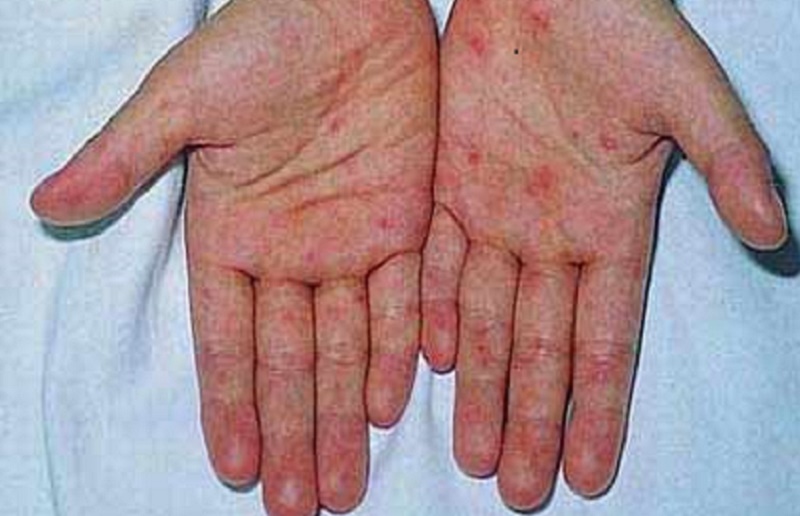 Nổi ban da là một triệu chứng điển hình của sốt xuất huyết mà không có ở sốt siêu vi.