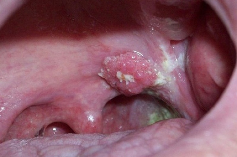Ung thư vòm họng bởi HPV.