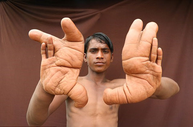 Cậu bé Tarik 12 tuổi có đôi tay to từ khi mới sinh ra. (Nguồn: Daily Mail)