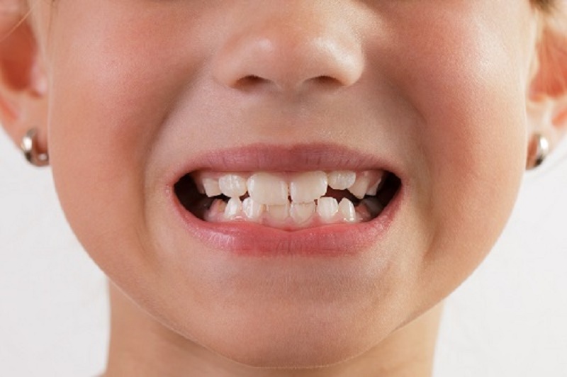 Nghiến răng không những gây tổn hại đến cấu trúc răng mà còn làm dị dạng hàm.
