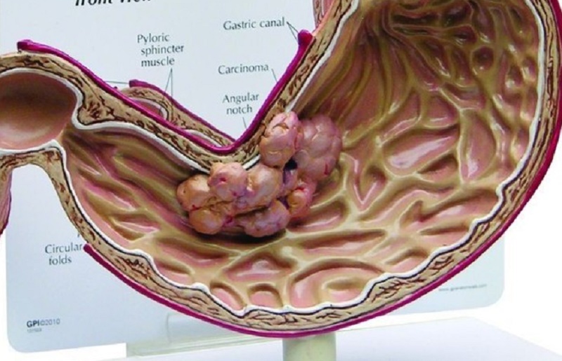 Hình ảnh mô phỏng ung thư dạ dày.