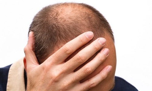 Chất PTD-DMB có thể ngăn ngừa rụng tóc và thúc đẩy tóc mọc lại. Ảnh: Har Vokse.