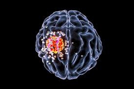Khối u não cứng đầu với hóa trị lại có thể bị ngăn chặn bằng cách ức chế enzyme CDK5 trong các tế bào gốc của u thần kinh - Ảnh : Medical News Today
