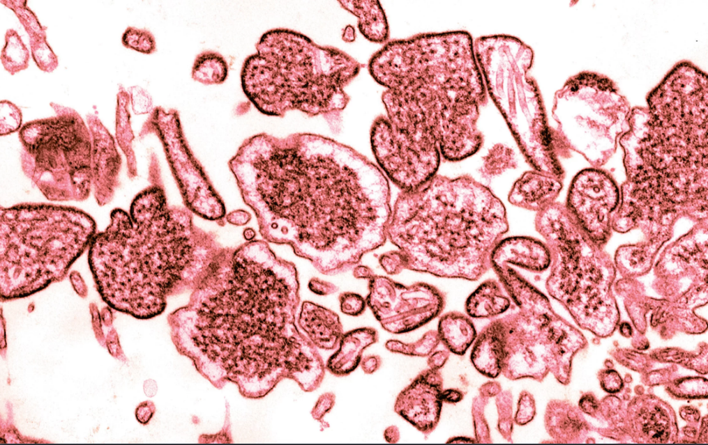 Virus Napah trên một mẫu dịch tủy lấy từ người nhiễm bệnh. Ảnh: BSIP/UIG/Getty 