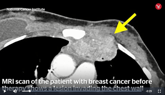 Khối u rất lớn trong ngực bà Perkins thể hiện trên phim MRI - ảnh cắt từ clip của NCI
