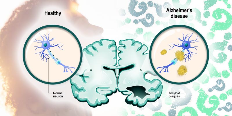 Sơ đồ biểu thị não của người mắc bệnh Alzheimer. Nguồn: Cannabis.info
