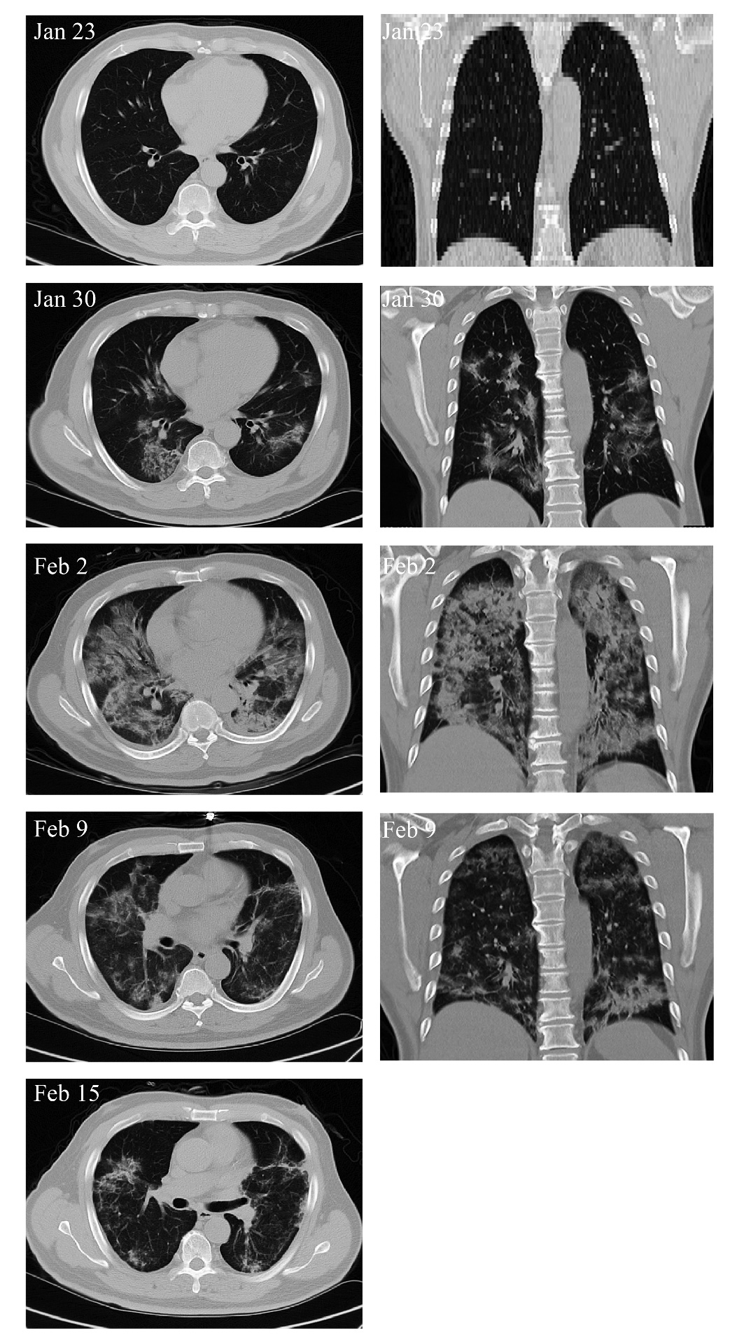 Hình ảnh chụp cắt lớp vi tính (CT) ngực của bệnh nhân Covid-19.