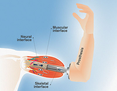 Biểu đồ minh họa cơ chế tương tác giữa cánh tay giả với các dây thần kinh và cơ bắp của cơ thể.