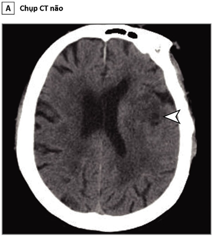 Chụp CT cho thấy các thương tổn thần kinh ở các ca nhiễm COVID-19. Ảnh: JAMA Neurology.