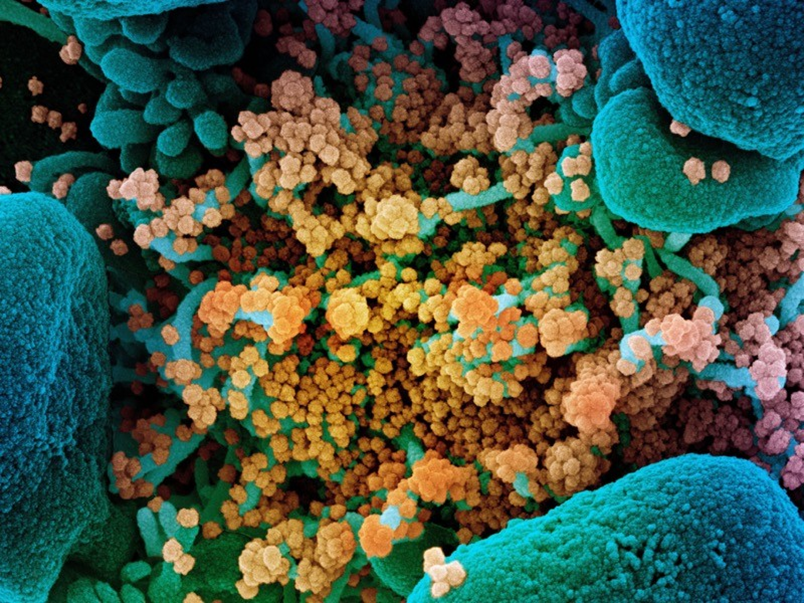 Hình ảnh kính hiển vi điện tử quét của các hạt coronavirus SARS-CoV-2 (màu cam) trên một tế bào (màu xanh). Ảnh: NIAID / NIH / SPL