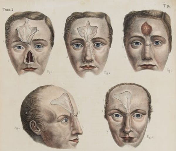Phần da trên trán được dùng trong các ca phẫu thuật tạo hình mũi thời kỳ đầu. Ảnh: Independent.