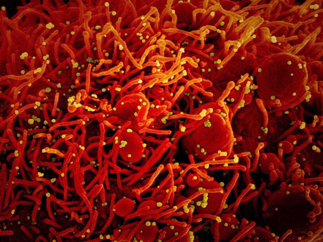 Virus SARS-CoV-2 trên tế bào chụp bằng kính hiển vi điện tử. Ảnh: NIAID / NIH / SPL