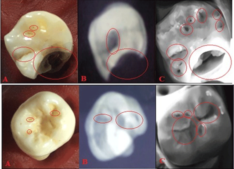 Kết quả chụp trên răng dưới ánh sáng thường (A); chụp bằng tia X (B); chụp bằng công nghệ NIR (C).
