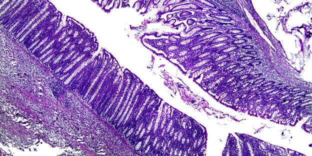 Mặt cắt kính hiển vi qua mô của ung thư biểu mô trực tràng. Nguồn: taz.de