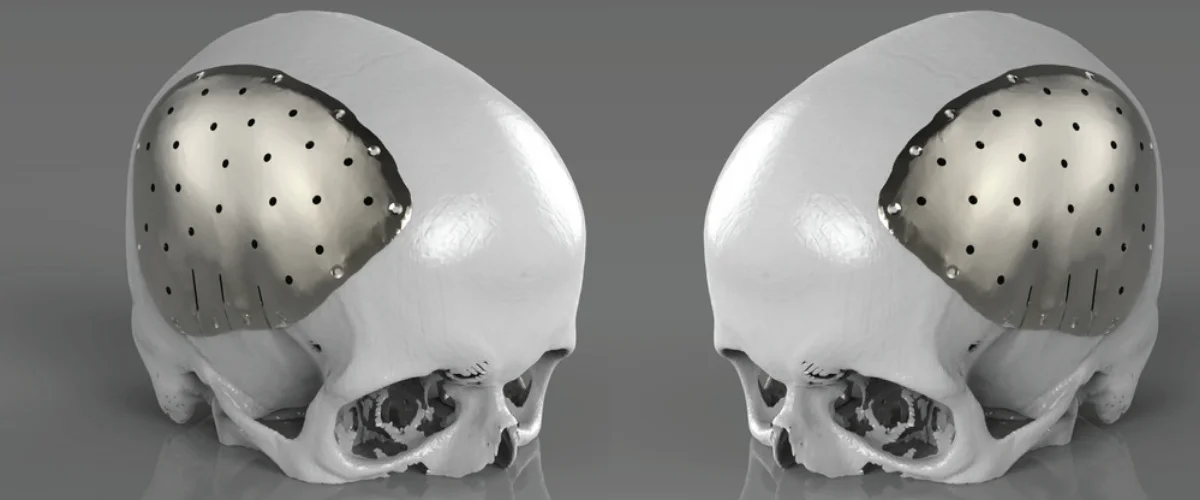 File in 3D mô hình hộp sọ phục vụ cho việc tạo miếng vá hộp sọ. 