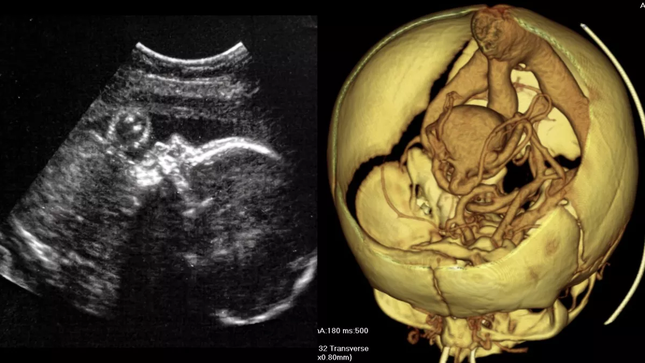 Hình ảnh bên trái cho thấy kết quả siêu âm của một em bé khỏe mạnh trong tử cung. Hình ảnh bên phải cho thấy sơ đồ 3D của các mạch máu trong não của trẻ sơ sinh, cho thấy một dị tật được gọi là "dị dạng tĩnh mạch Galen"