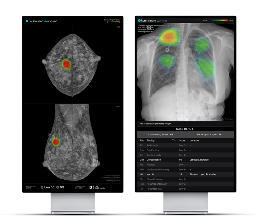 AI phân tích hình ảnh X-quang để tạo ra các bản đồ nhiệt đánh dấu những vị trí tổn thương bất thường. Ảnh: Lunit