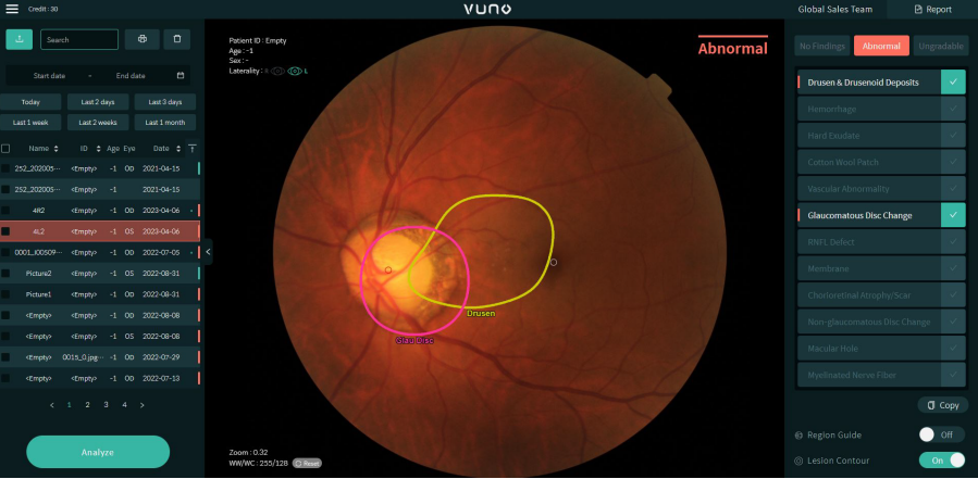 Phần mềm VUNO Med Fundus AI có thể xác định 12 dấu hiệu cần thiết cho các bệnh võng mạc dựa trên hình ảnh đáy mắt. Ảnh: VUNO
