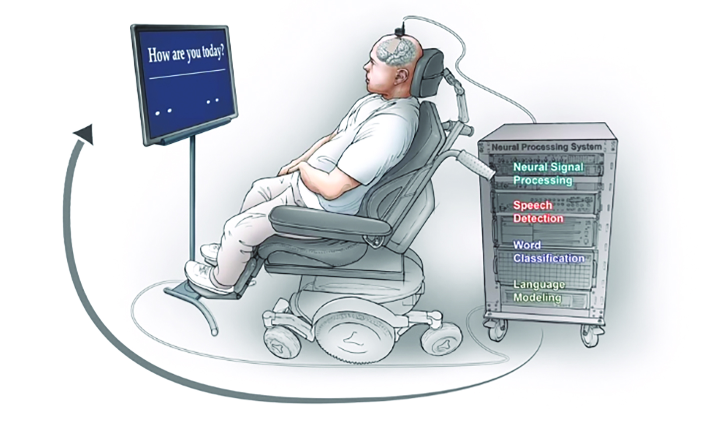 Hình ảnh người bệnh giao tiếp thông qua giao diện não-máy tính. Nguồn: Đại họcCalifornia San Francisco